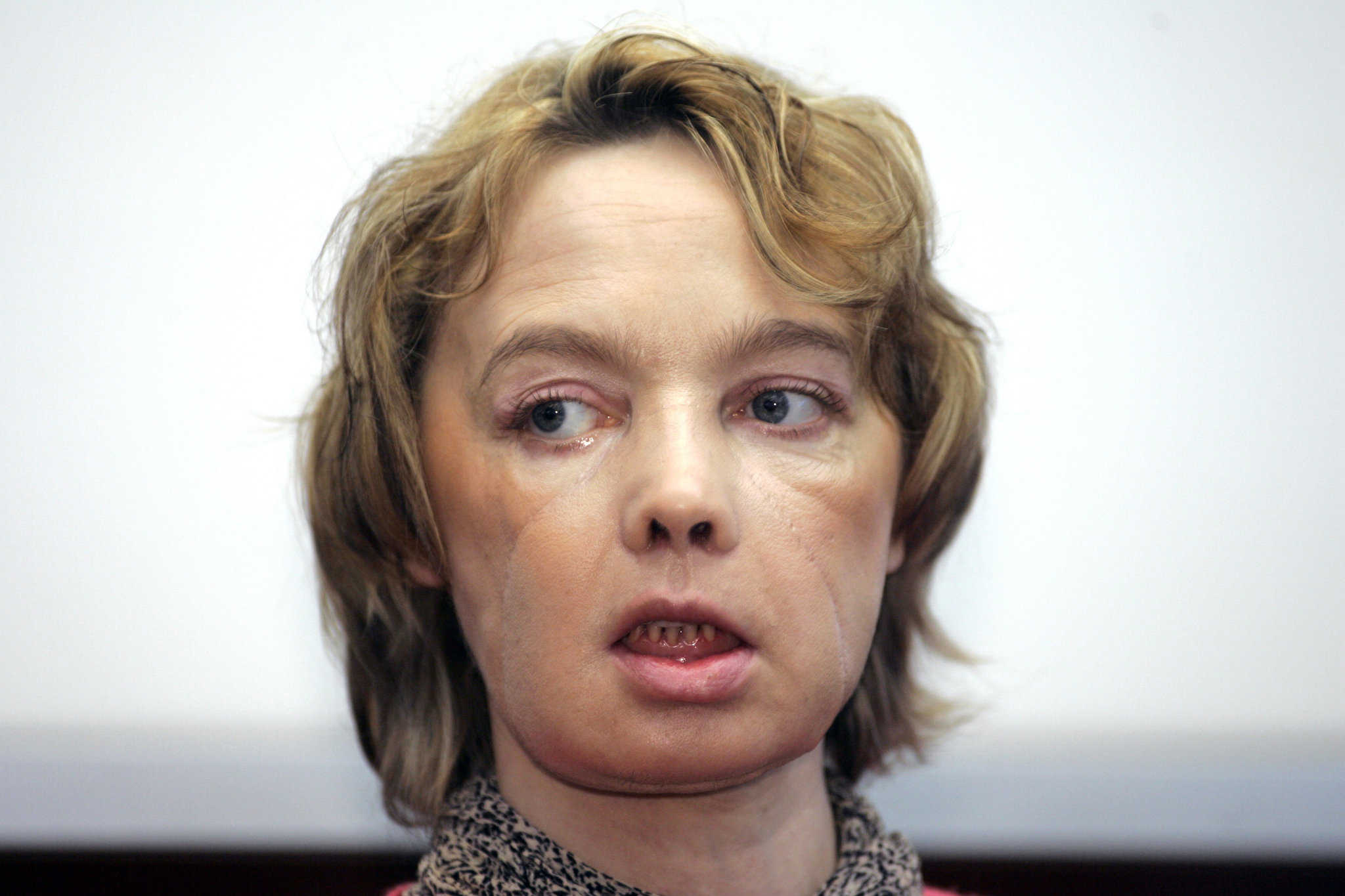 Isabelle Dinoire, first face transplant recipient, dies at 49